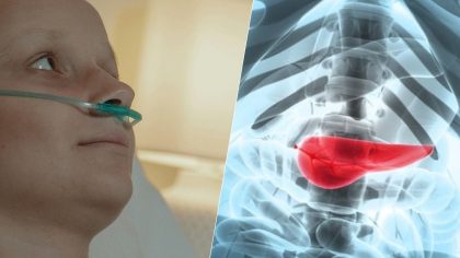 Cancer du pancréas : quel facteur de risque peut-on vraiment réduire ?