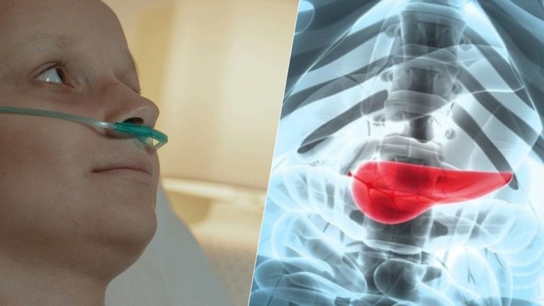 Cancer du pancréas : quel facteur de risque peut-on vraiment réduire ?