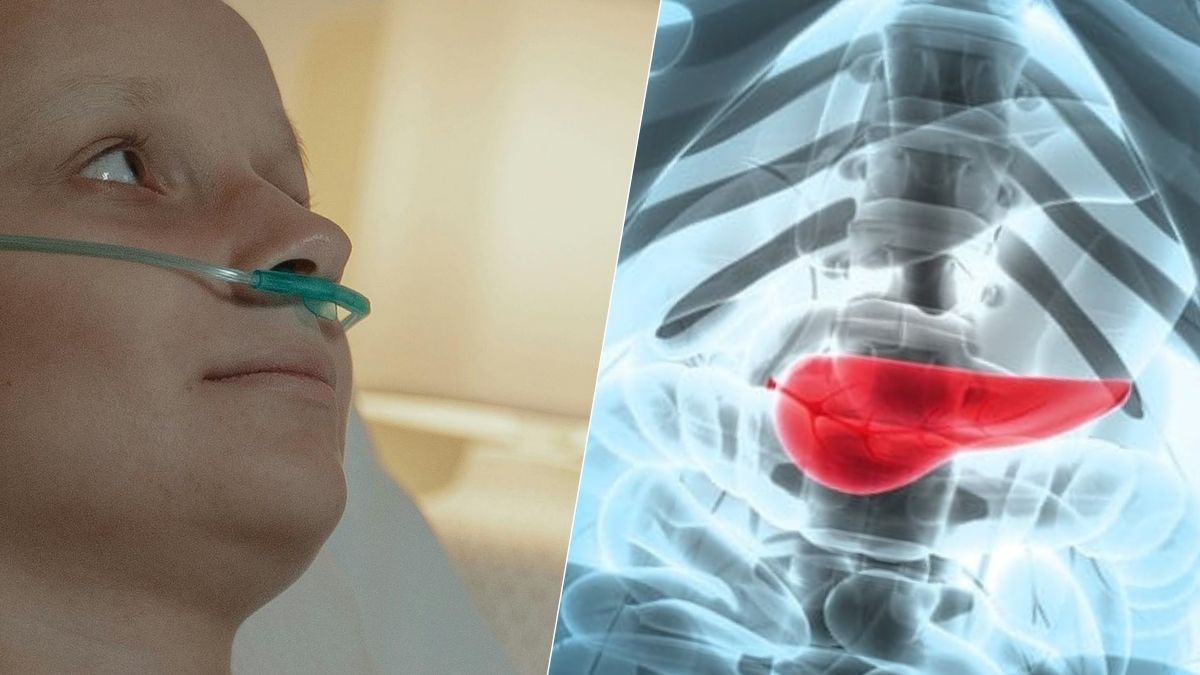 Cancer du pancréas : quel facteur de risque peut-on vraiment réduire ?